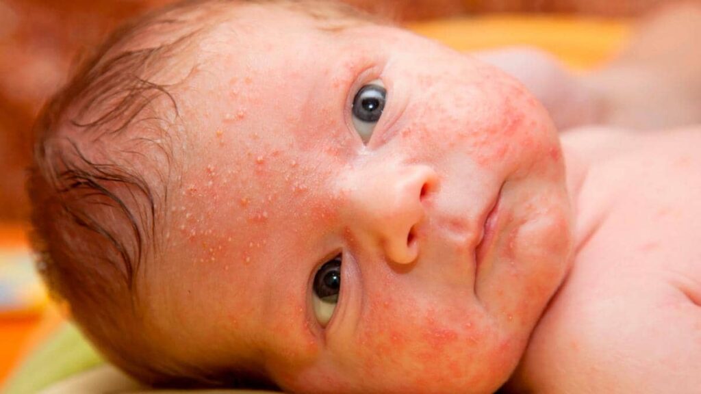 Impetigo en bebés