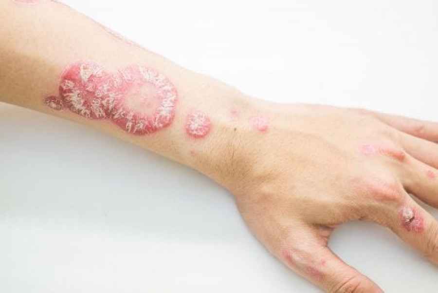 Psoriasis