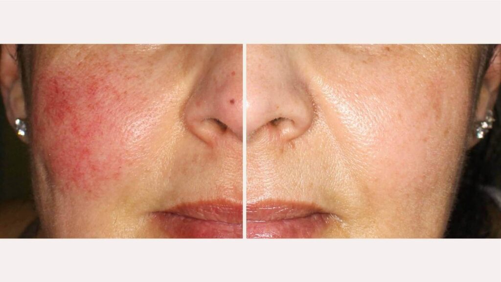 rosacea antes y despues