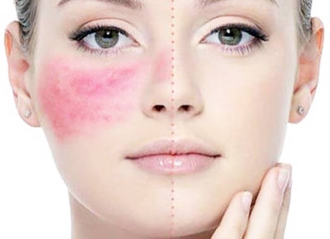 rosacea antes y despues 1