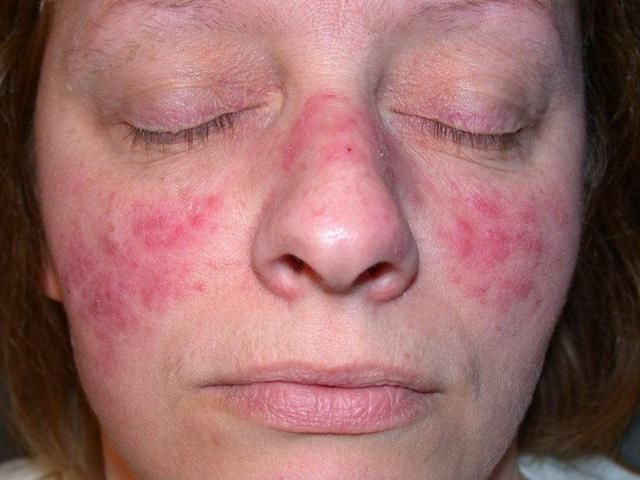 rosacea en el rostro